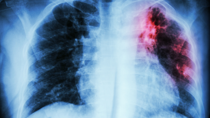 Tuberkulos är en infektionssjukdom som främst påverkar lungorna. Foto: Shutterstock
